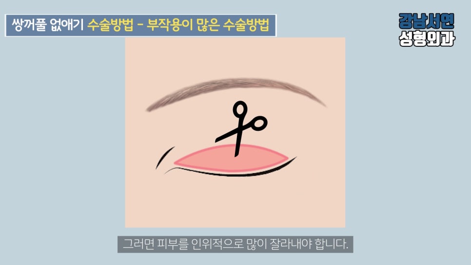 남자 눈성형 설명 도해