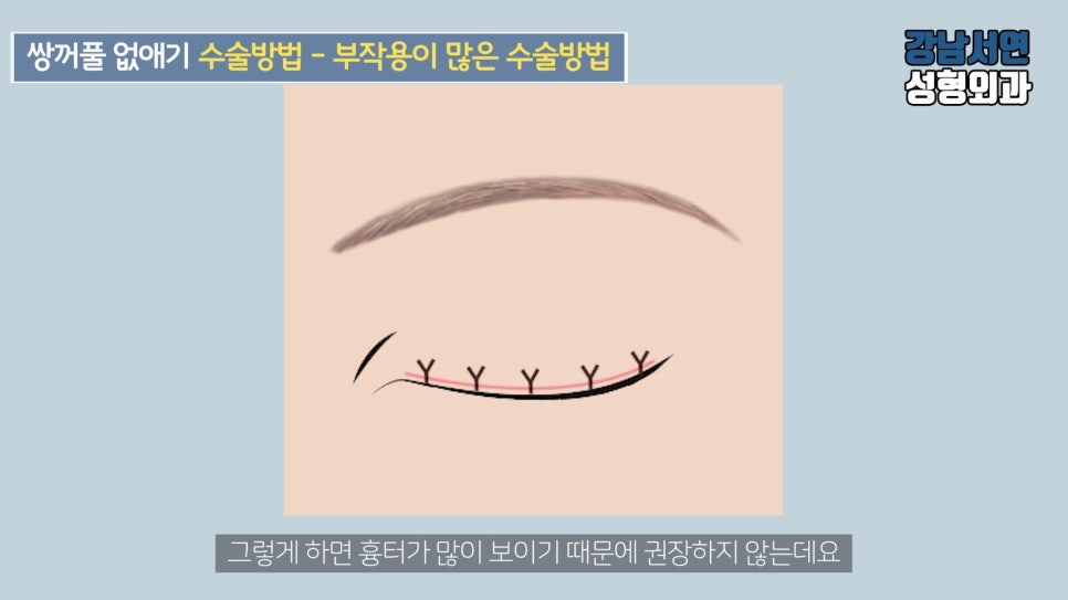 남자 눈성형 설명 도해