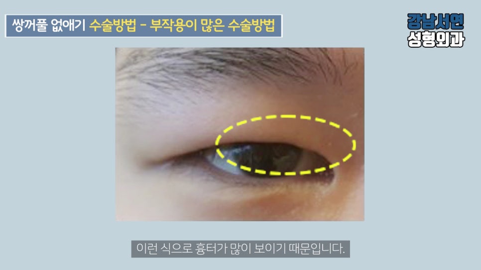 남자 눈성형 수술 사례 눈 사진