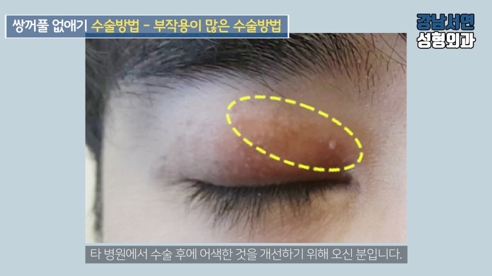 남자 눈성형 수술 사례 눈 사진