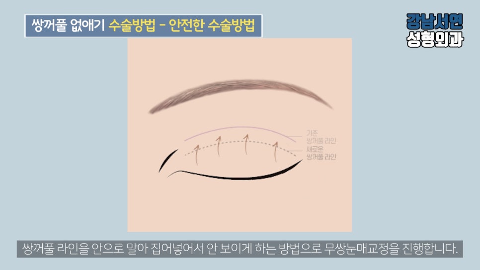 남자 눈성형 설명 도해