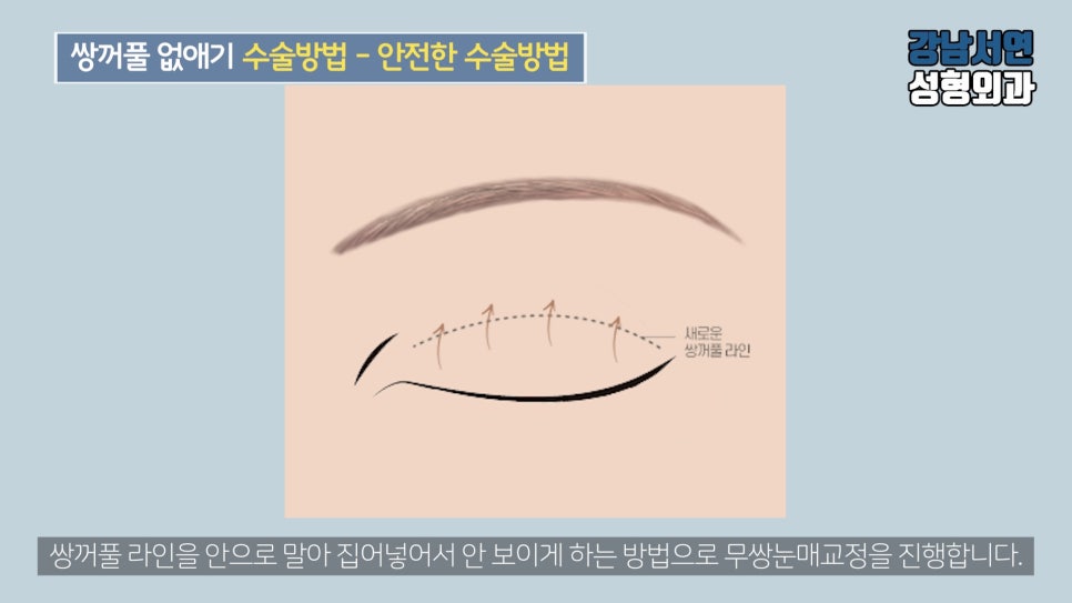 남자 눈성형 설명 도해