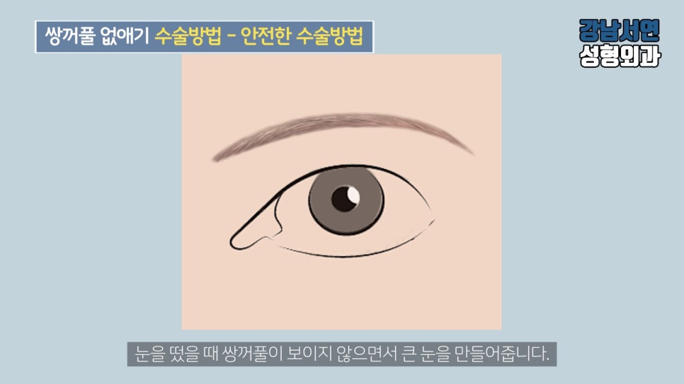 남자 눈성형 설명 도해