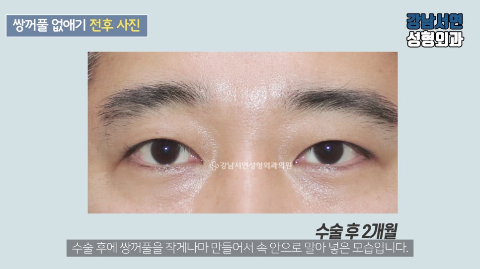 남자 눈성형 수술 후 사진