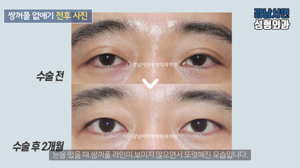 남자 눈성형 수술 전후 비교 사진