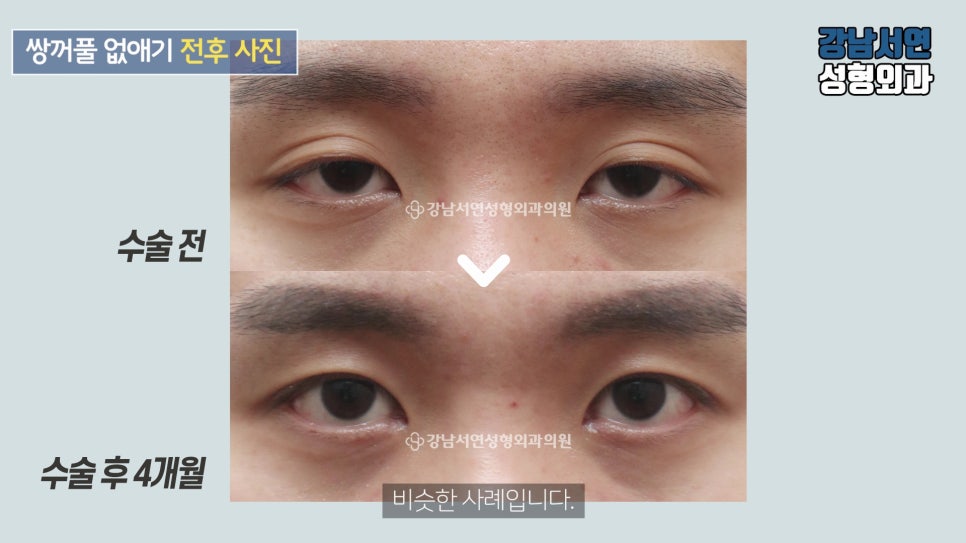 남자 눈성형 수술 전후 비교 사진