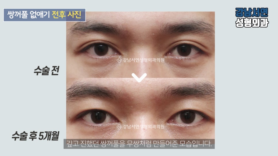 남자 눈성형 수술 전후 비교 사진