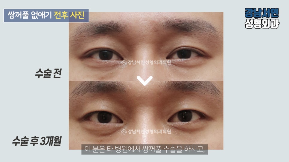 남자 눈성형 수술 전후 비교 사진