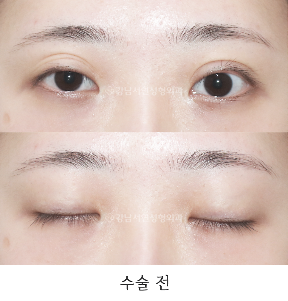 쌍꺼풀 재수술 전 사진