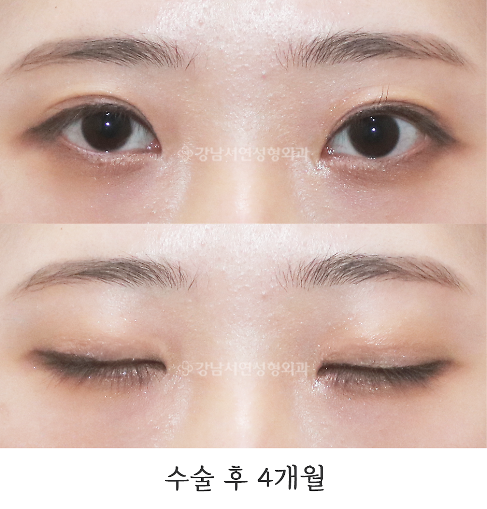 쌍꺼풀 재수술 후 사진