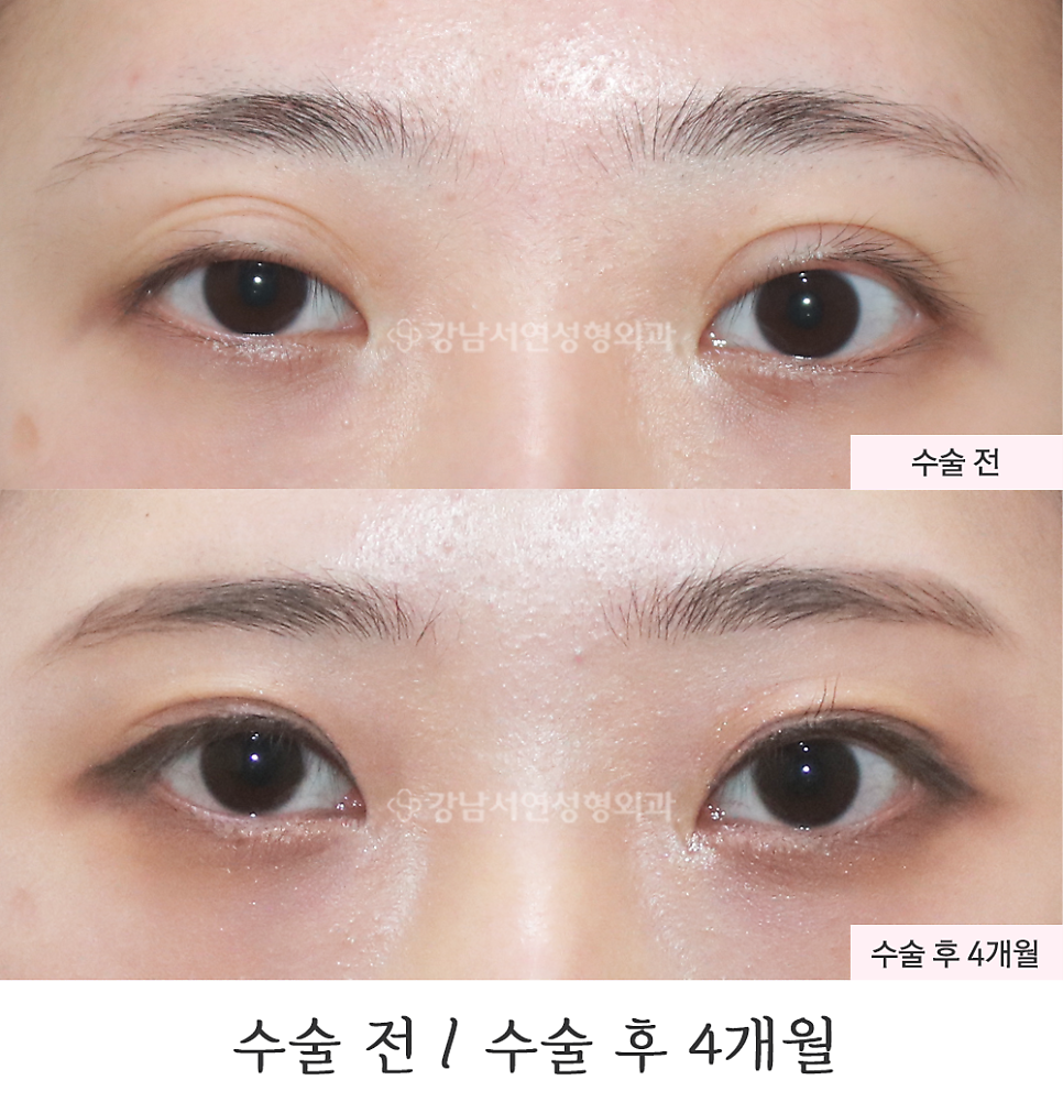 쌍꺼풀 재수술 전후 비교 사진