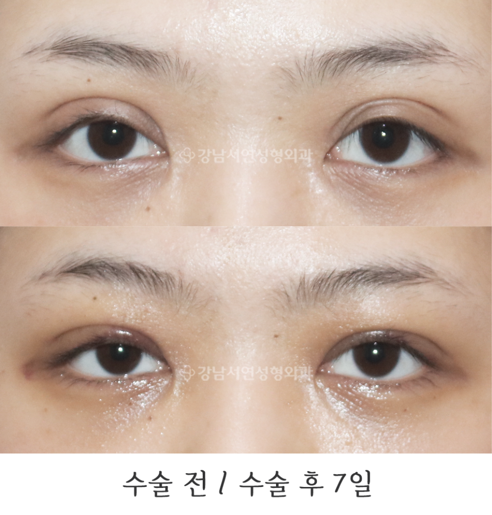 눈성형 수술 전후 비교 사진