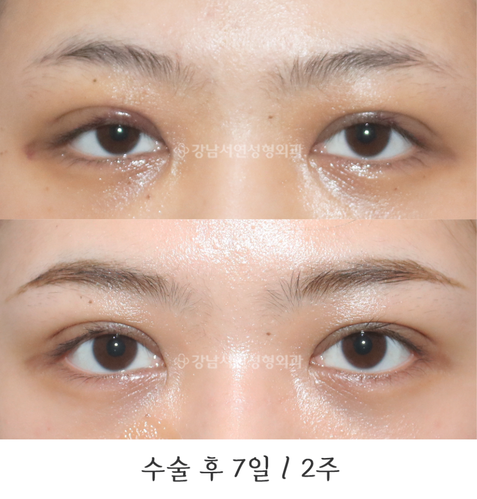 눈성형 수술 전후 비교 사진