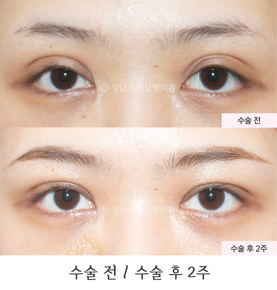 눈성형 수술 전후 비교 사진