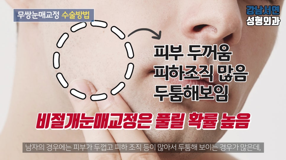 남자 눈성형 설명 도해