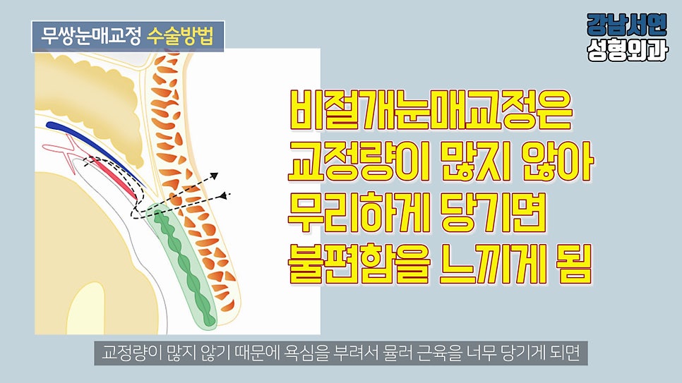 남자 눈성형 설명 도해