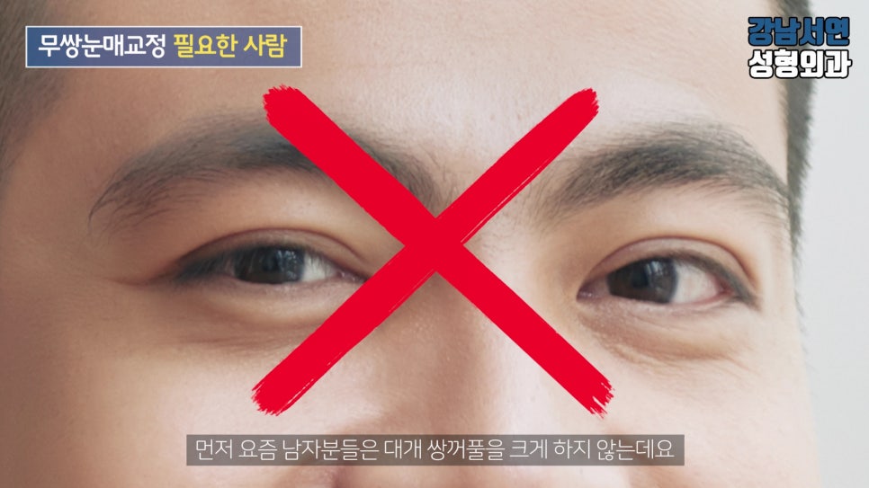 남자 눈성형 설명 도해