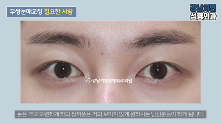 남자 눈성형 수술 사례 눈 사진