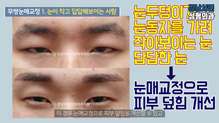 남자 눈성형 수술 전후 비교 사진