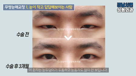 남자 눈성형 수술 전후 비교 사진