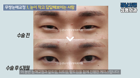 남자 눈성형 수술 전후 비교 사진