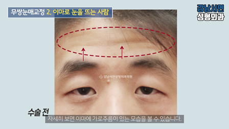 남자 눈성형 수술 전 사진