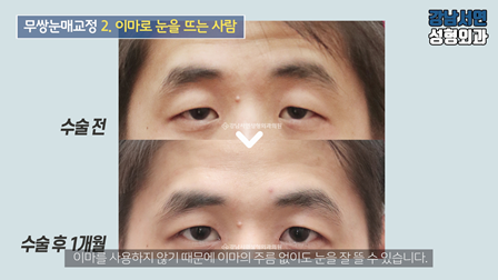남자 눈성형 수술 전후 비교 사진