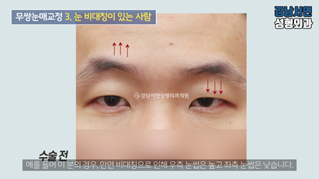 남자 눈성형 수술 전 사진
