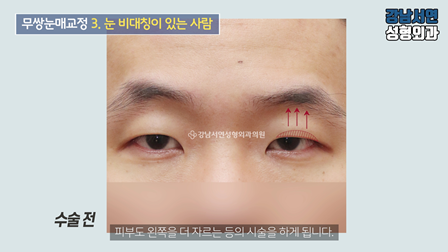 남자 눈성형 수술 전 사진