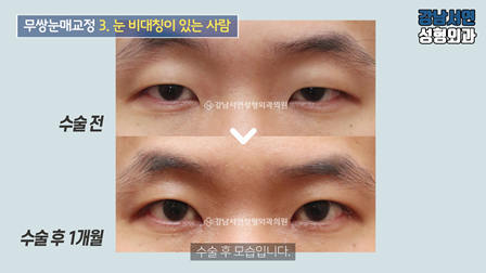 남자 눈성형 수술 전후 비교 사진
