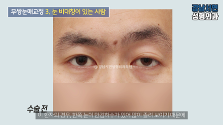 남자 눈성형 수술 전 사진