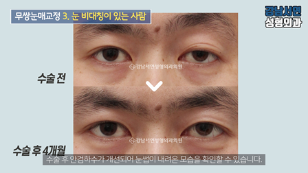 남자 눈성형 수술 전후 비교 사진