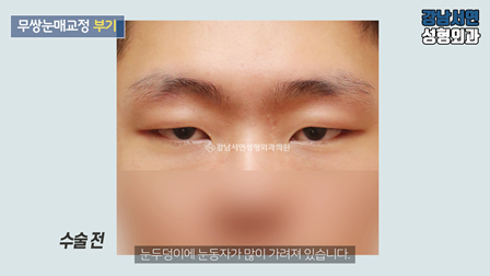 남자 눈성형 수술 전 사진