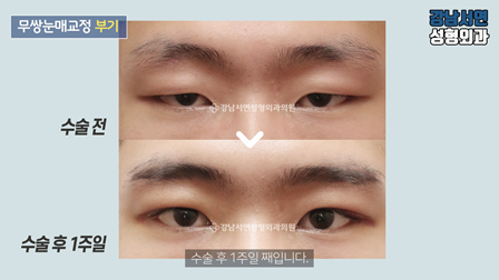 남자 눈성형 수술 전후 비교 사진