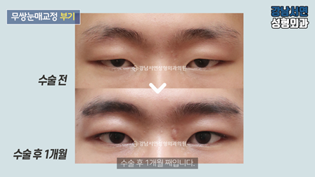 남자 눈성형 수술 전후 비교 사진