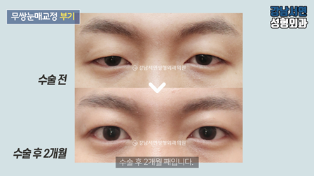 남자 눈성형 수술 전후 비교 사진