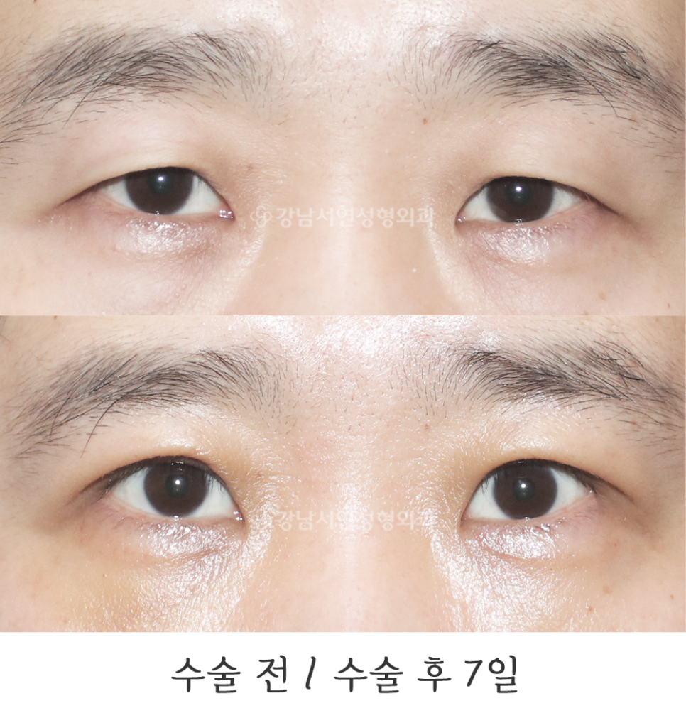 남자 눈성형 수술 전후 비교 사진