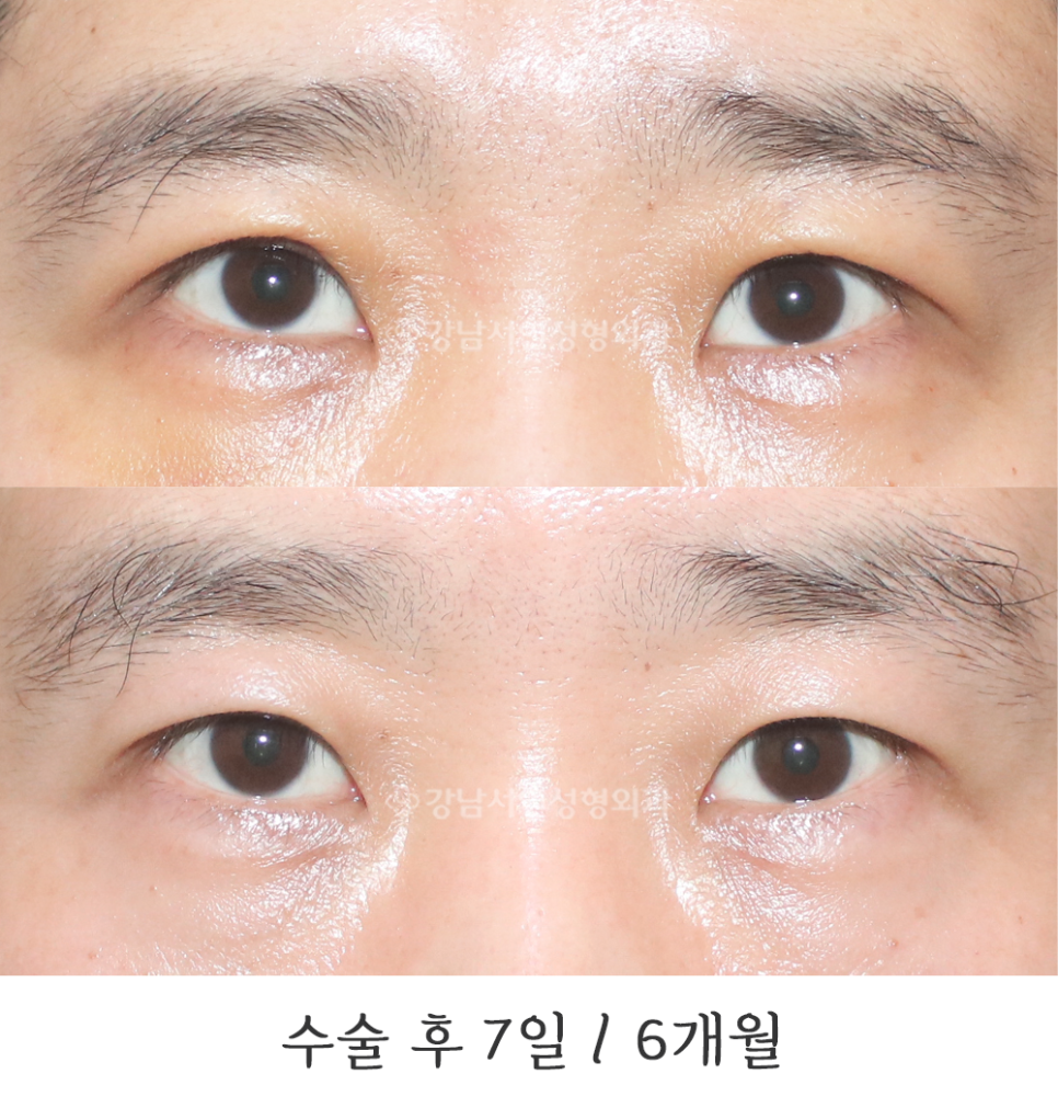 남자 눈성형 수술 전후 비교 사진