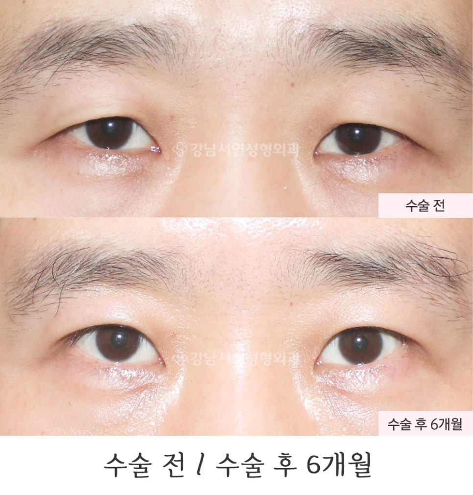남자 눈성형 수술 전후 비교 사진