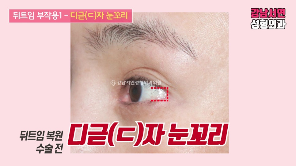 쌍꺼풀 재수술 사례 눈 사진