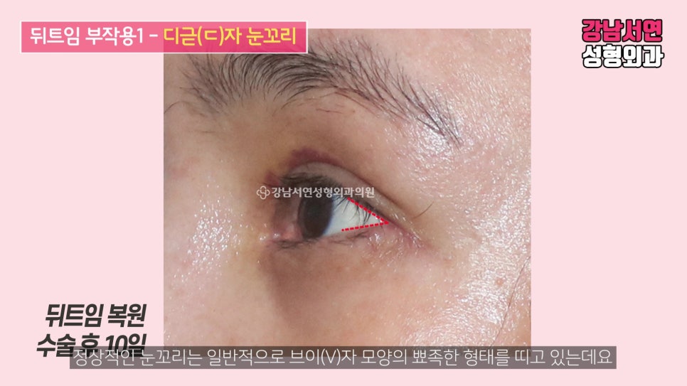 쌍꺼풀 재수술 사례 눈 사진