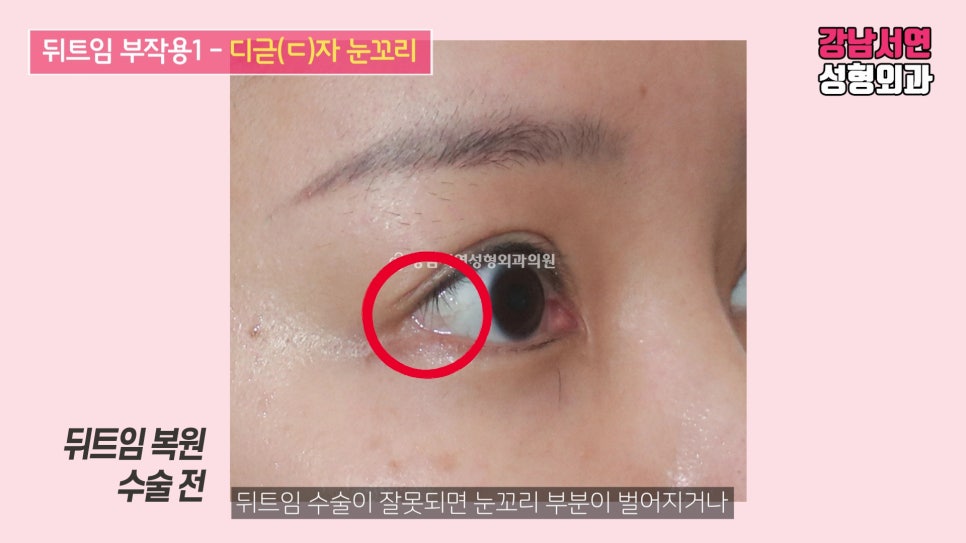 쌍꺼풀 재수술 사례 눈 사진