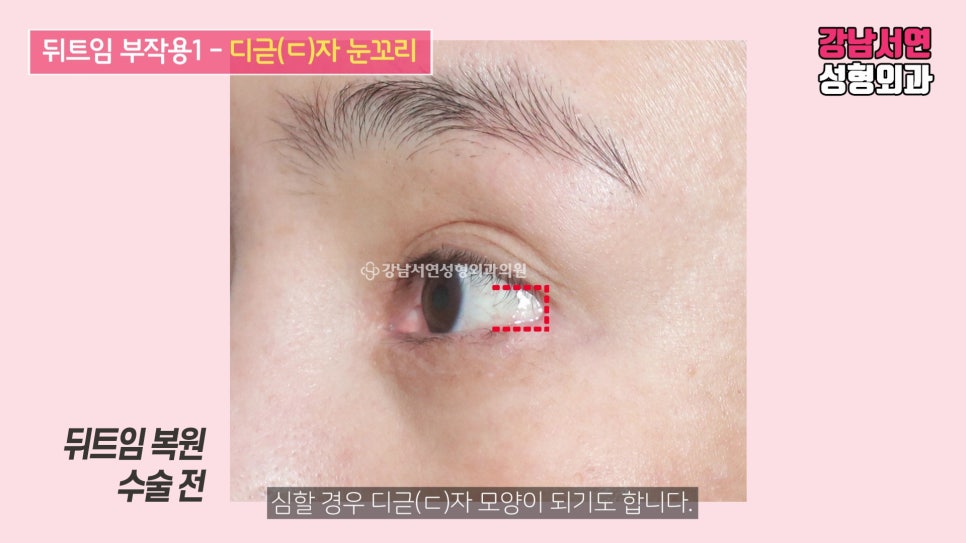 쌍꺼풀 재수술 사례 눈 사진