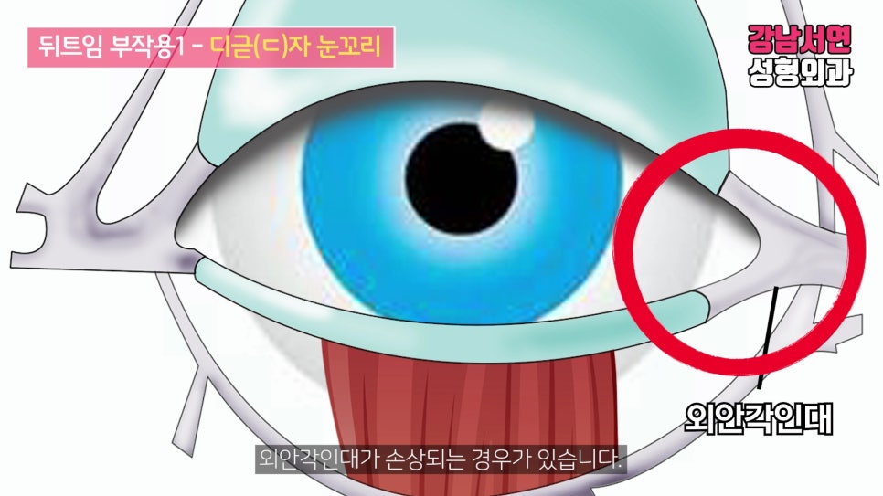 쌍꺼풀 재수술 설명 도해