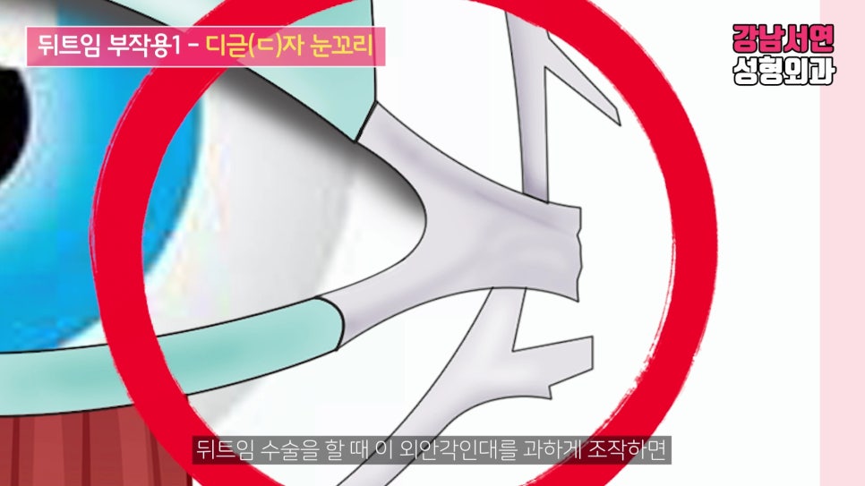 쌍꺼풀 재수술 설명 도해