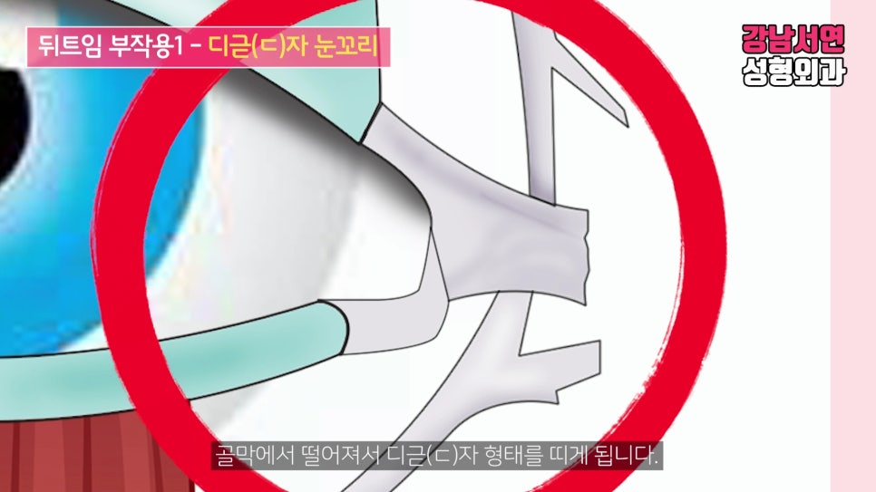 쌍꺼풀 재수술 설명 도해