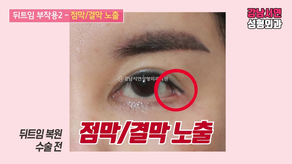 쌍꺼풀 재수술 사례 눈 사진