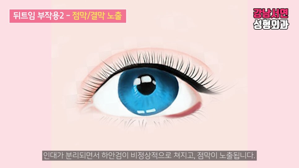 쌍꺼풀 재수술 설명 도해