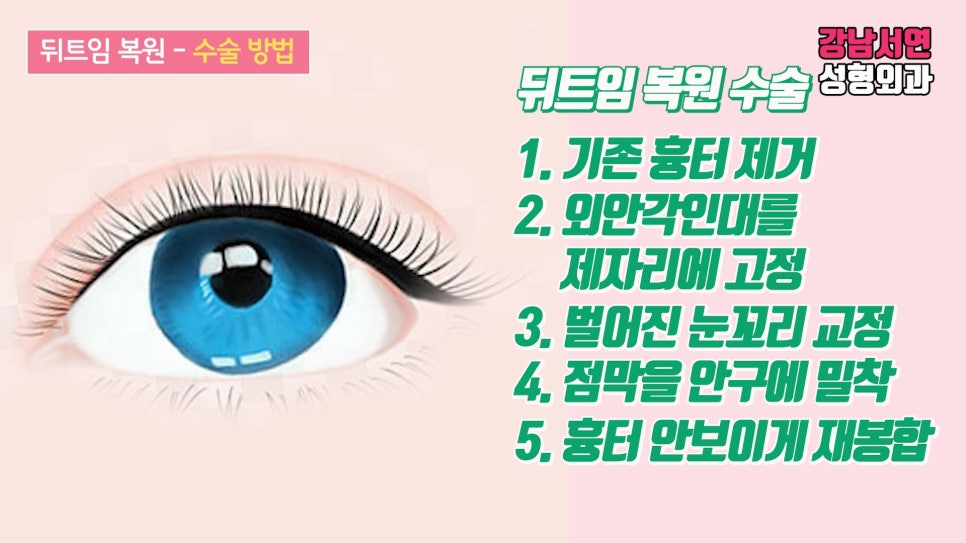 쌍꺼풀 재수술 설명 도해