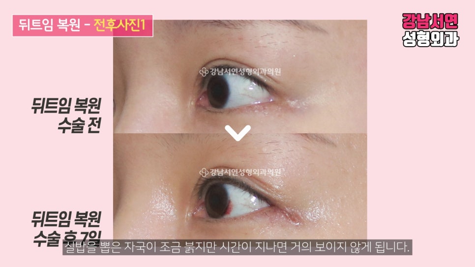 쌍꺼풀 재수술 전후 비교 사진